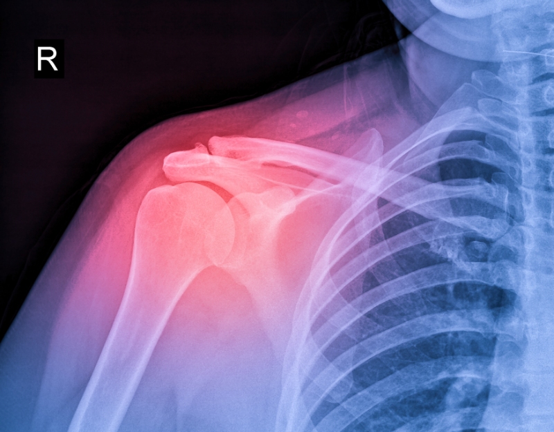 Rotator Cuff Shoulder Injuries  Denver, CO